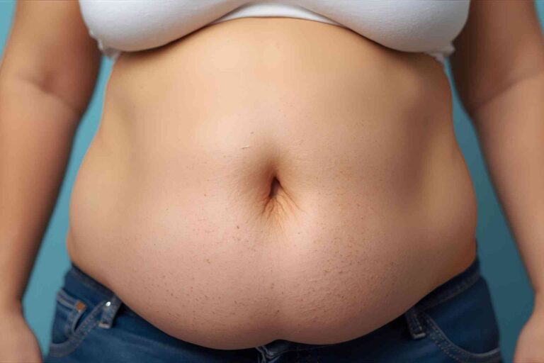 شفط الدهون ومؤشر كتلة الجسم (BMI) المرتفع